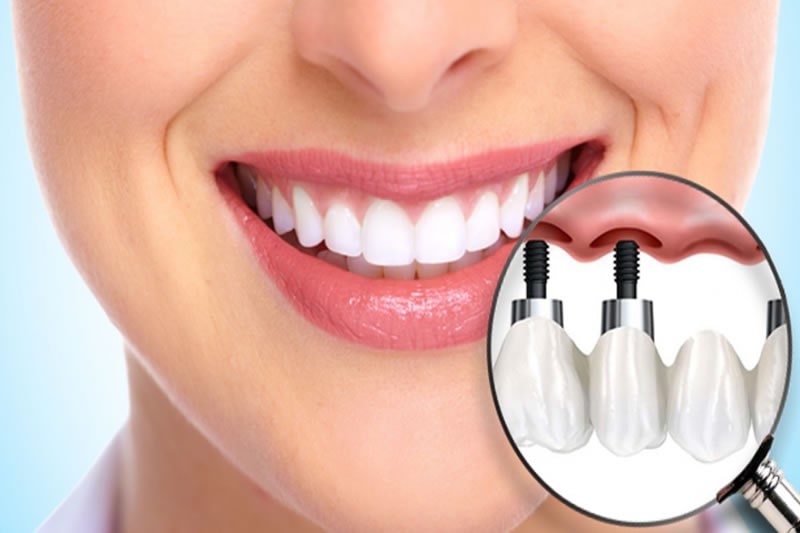 Implant Üstü Protezler